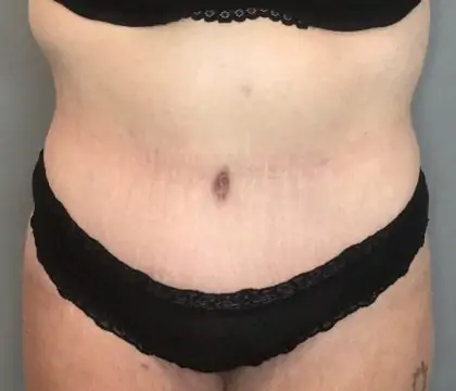 After Image: Tummy Tuck - front