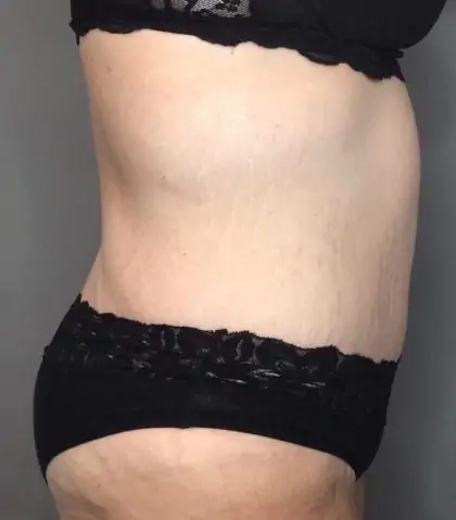 After Image: Tummy Tuck - right-side