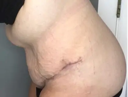 After Image: Tummy Tuck - other