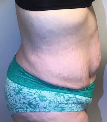 Before Image: Tummy Tuck - right-side