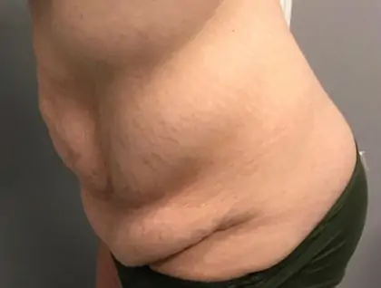 Before Image: Tummy Tuck - other