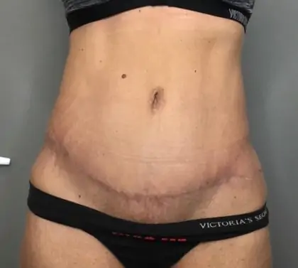 After Image: Tummy Tuck - front