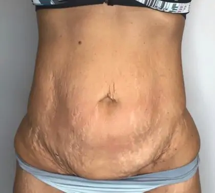 Before Image: Tummy Tuck - front