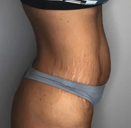 Before Image: Tummy Tuck - right-side
