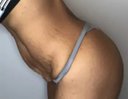 Before Image: Tummy Tuck - other