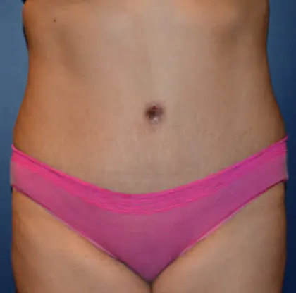 After Image: Tummy Tuck - front