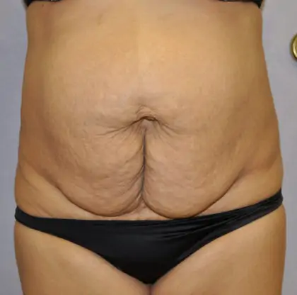 Before Image: Tummy Tuck - front