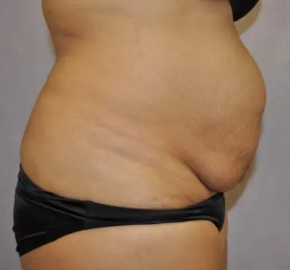 Before Image: Tummy Tuck - right-side