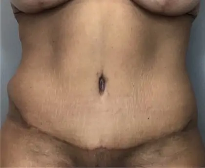 After Image: Tummy Tuck - front