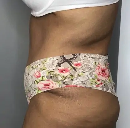 After Image: Tummy Tuck - left-side