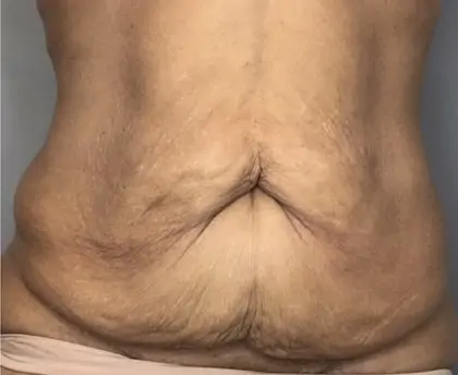 Before Image: Tummy Tuck - front