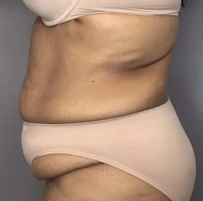 Before Image: Tummy Tuck - left-side