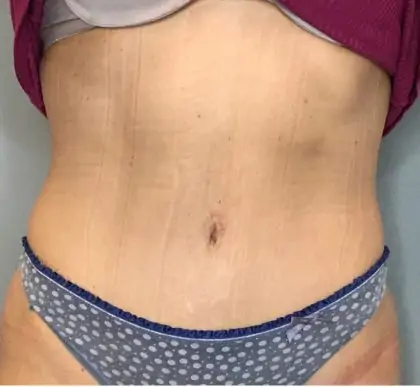 After Image: Tummy Tuck - front