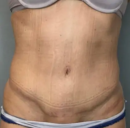 Before Image: Tummy Tuck - front