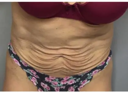 Before Image: Tummy Tuck - back