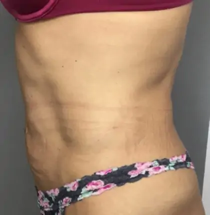 Before Image: Tummy Tuck - left-side