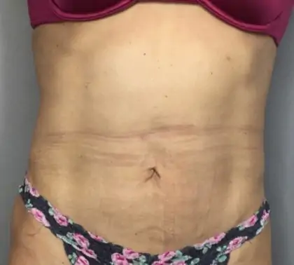 Before Image: Tummy Tuck - front