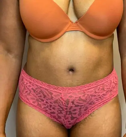 After Image: Tummy Tuck - front