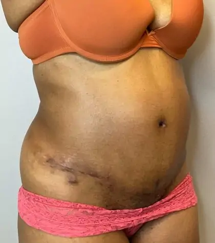 After Image: Tummy Tuck - right-front-oblique