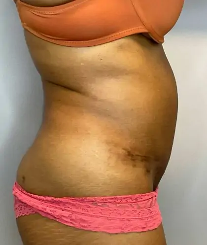 After Image: Tummy Tuck - right-side