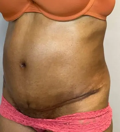 After Image: Tummy Tuck - left-front-oblique