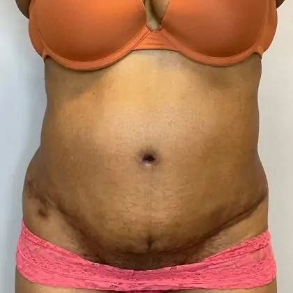 After Image: Tummy Tuck - front