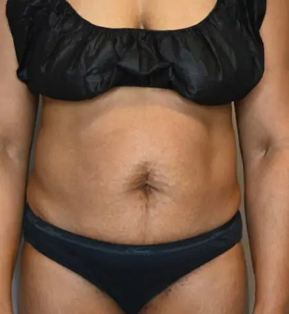 Before Image: Tummy Tuck - front