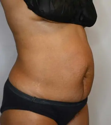 Before Image: Tummy Tuck - right-front-oblique