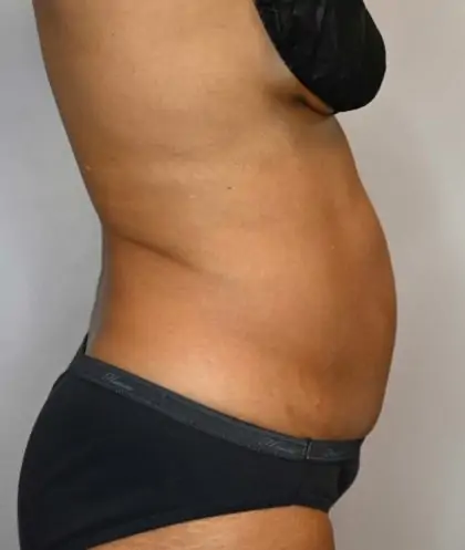 Before Image: Tummy Tuck - right-side