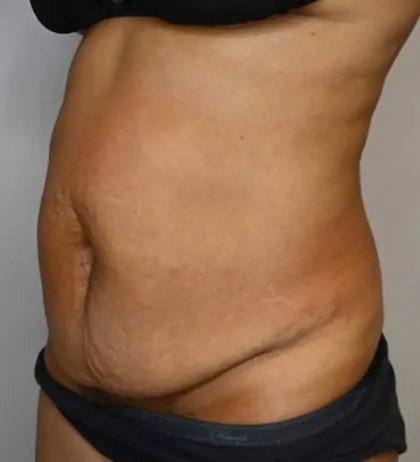 Before Image: Tummy Tuck - left-front-oblique