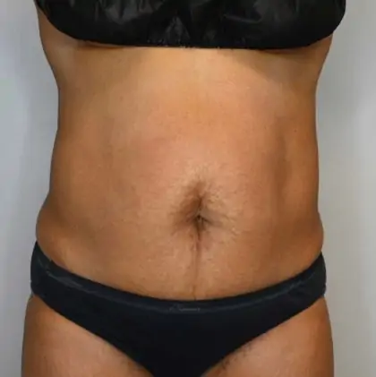 Before Image: Tummy Tuck - front