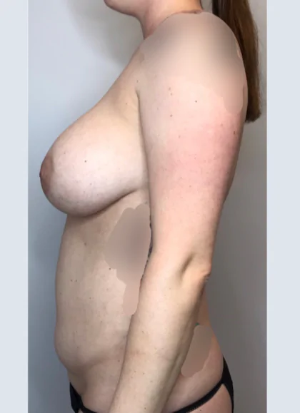 Before Image: Mommy Makeover, Liposuction - left-side