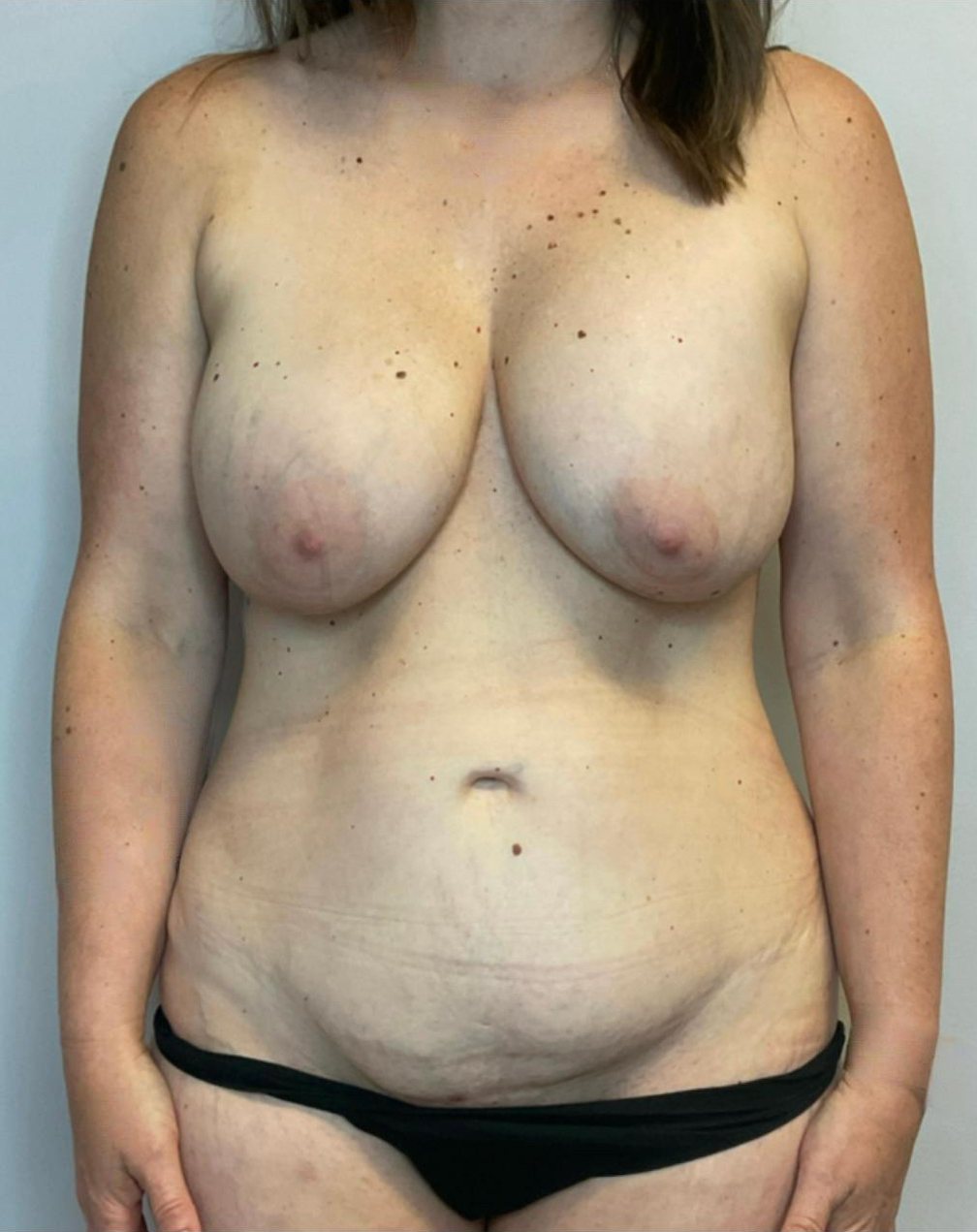 Before Image: Mommy Makeover - front