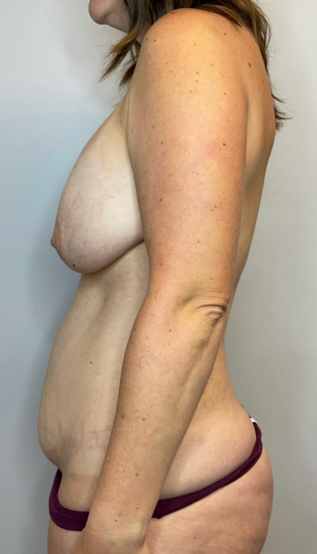 Before Image: Mommy Makeover - left-side