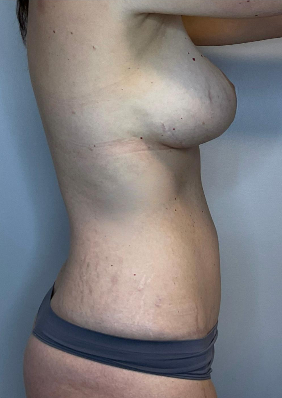 After Image: Mommy Makeover - right-side