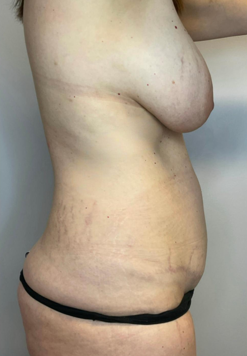 Before Image: Mommy Makeover - right-side