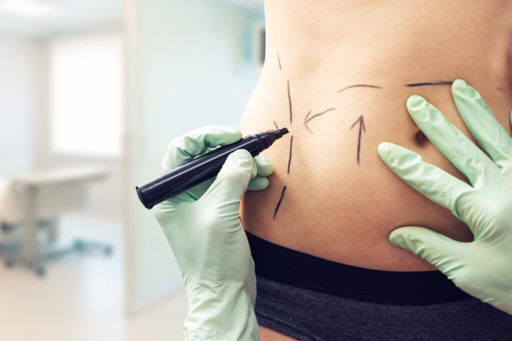A doctor marking a woman's abdomen for a mini tummy tuck in Raleigh