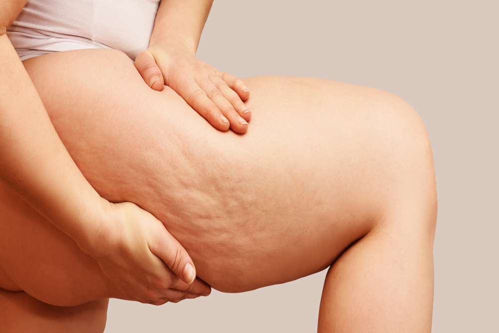 A close-up shot of cellulite on a woman's thigh before ZWave treatment