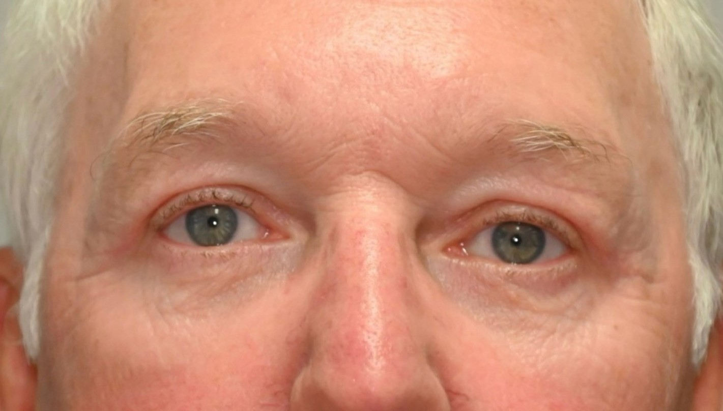 After Image: Blepharoplasty - front