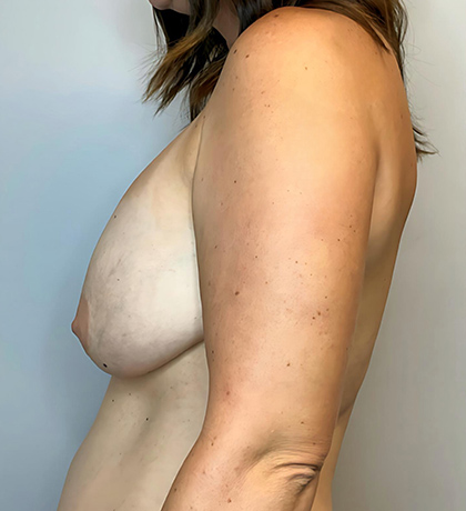 Before Image: Breast Augmentation with Lift - left-side