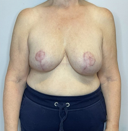 After Image: Breast Reduction - front