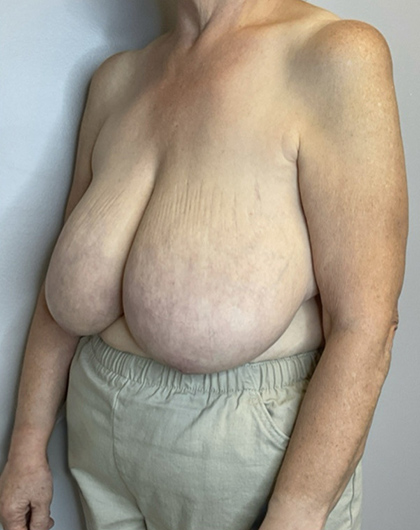 Before Image: Breast Reduction - left-front-oblique