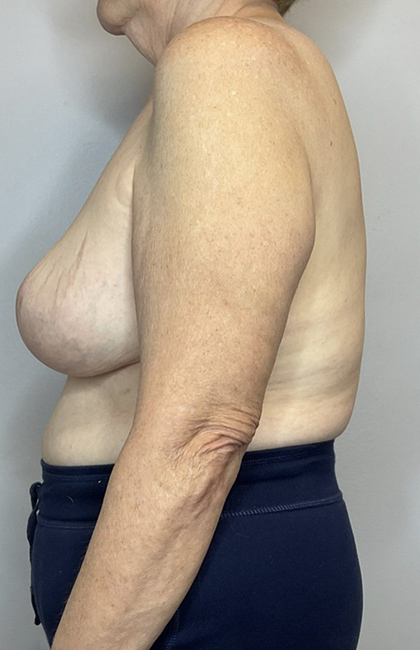 After Image: Breast Reduction - left-side