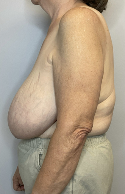 Before Image: Breast Reduction - left-side