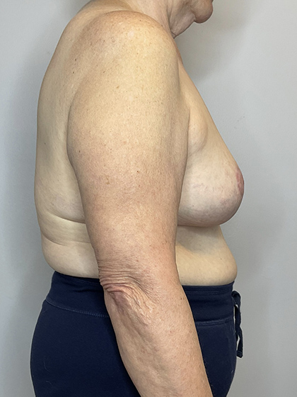 After Image: Breast Reduction - right-side