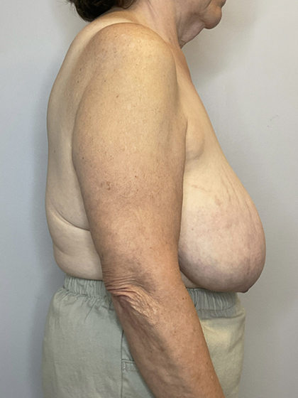 Before Image: Breast Reduction - right-side