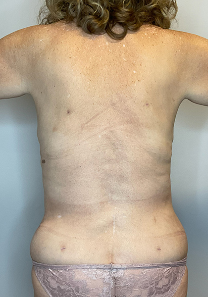 After Image: Mommy Makeover - back