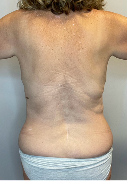 Before Image: Mommy Makeover - back