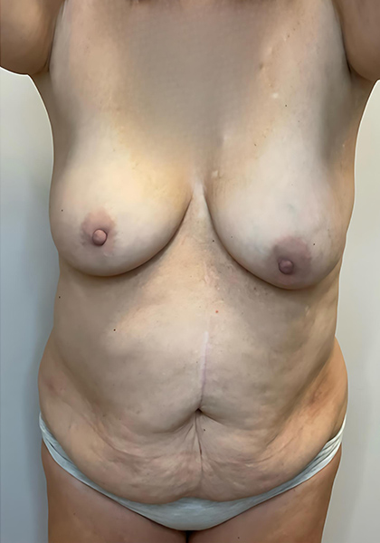 Before Image: Mommy Makeover - front