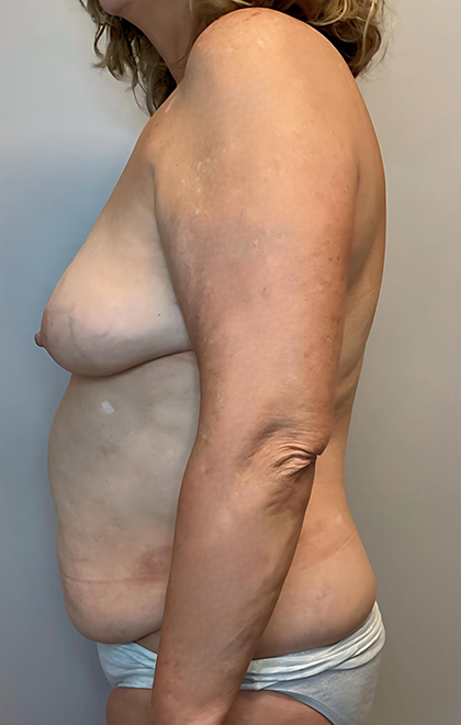 Before Image: Mommy Makeover - left-side